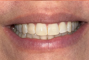Elite Dental of Towson | Digital Impressions, Emergency Treatment and Oral Cancer Screening