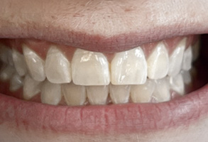 Elite Dental of Towson | CEREC reg , Pediatric Dentistry and Night Guards