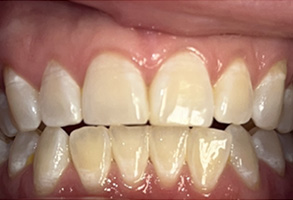 Elite Dental of Towson | TMJ Disorders, Preventative Program and Periodontal Treatment